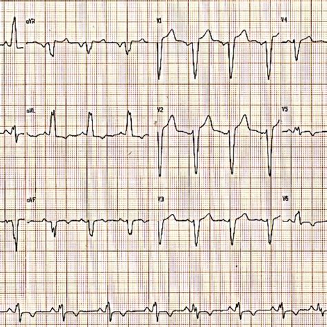 Image result for LBB ECG