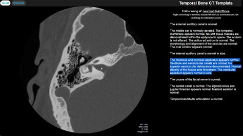 Toradh íomhá ar Temporal Bone CT Scan