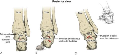 Subtalar Inversion に対する画像結果
