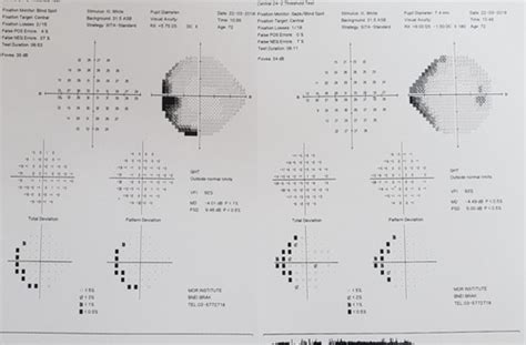 Image result for Ber Visual Field Defect
