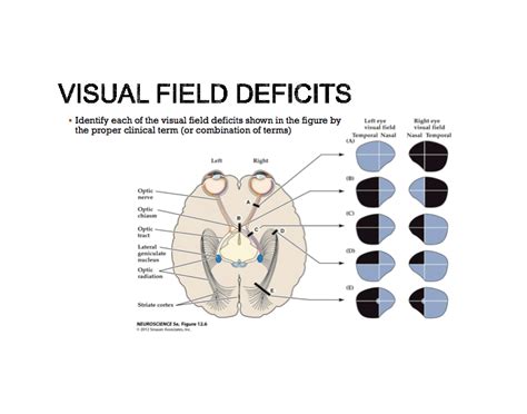 Image result for Deficit in One Visual Field