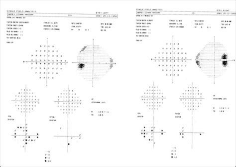 Image result for Ber Visual Field Defect