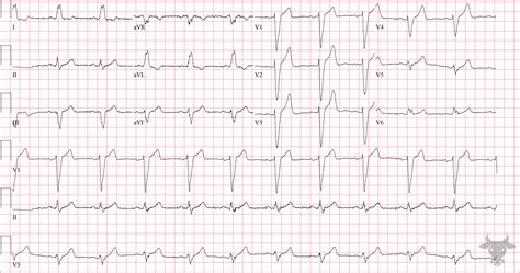Cardiac MRI Left Bundle Branch Block に対する画像結果