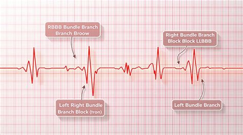Image result for LBB ECG