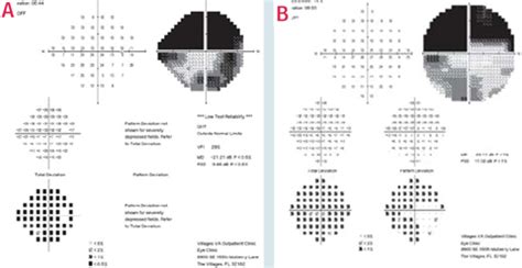 Image result for Visual Field Glaucoma Stages