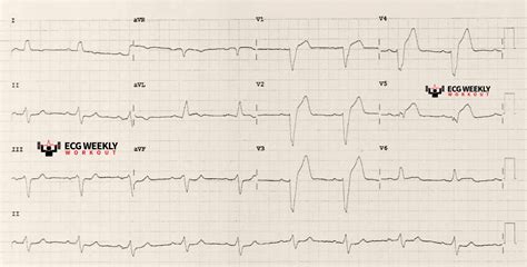 Image result for LBB ECG
