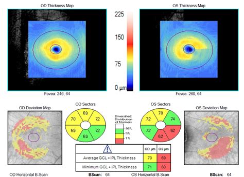 Image result for Glaucoma Visual Field Defects