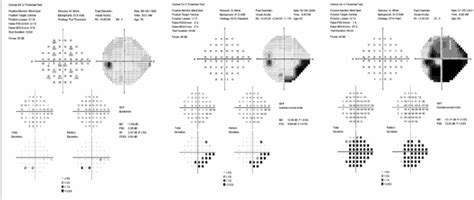Image result for Glaucoma Eye Damage Visual Field