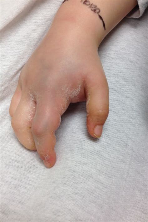 Copperhead Bite