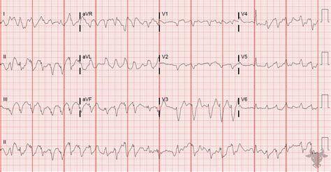 Cardiac MRI Left Bundle Branch Block に対する画像結果