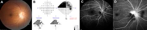 Image result for Altitudinal Visual Field Defect