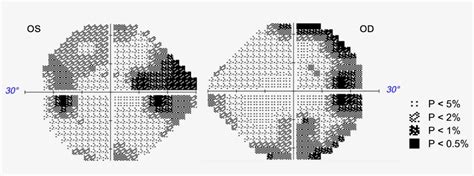 Bilateral Peripheral Visual Field Defect に対する画像結果