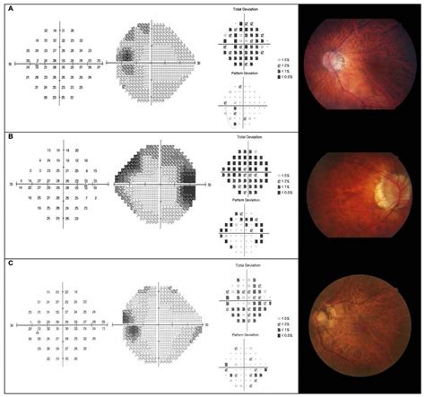 Image result for Macular Split Visual Field Glaucoma