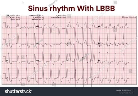 Toradh íomhá ar Left Bundle Branch Block and AFib