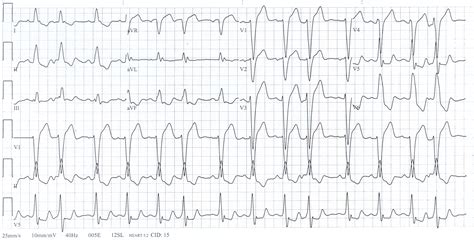 Toradh íomhá ar Left Bundle Branch Block and AFib