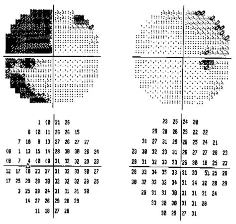 Image result for Temporal Visual Field Defect