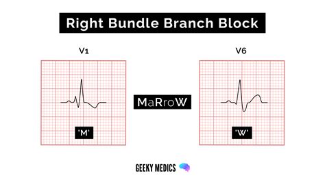 Toradh íomhá ar Left Bundle Branch Block and AFib