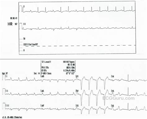 Toradh íomhá ar Left Bundle Branch Block and AFib