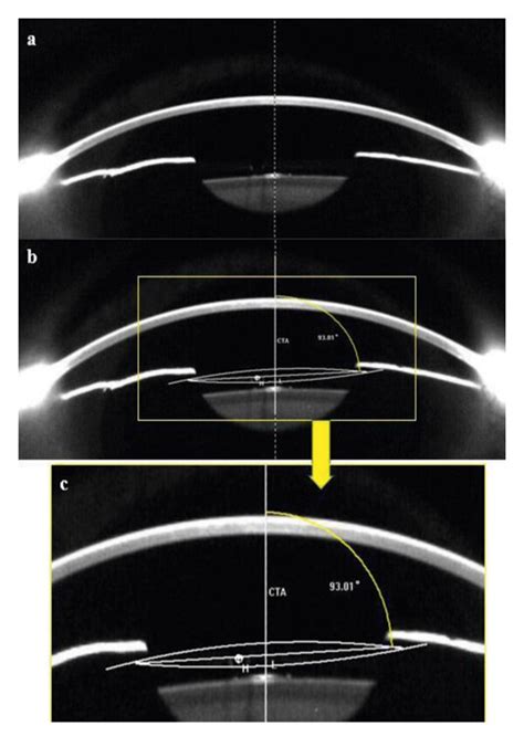 Image result for MATLAB Pentacam
