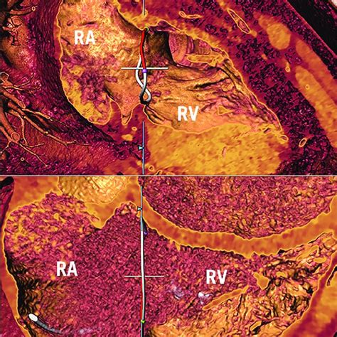 Afbeeldingsresultaten voor Peripheral Visual Field Defect