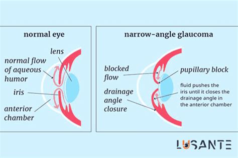 Tunnel Vision Visual Field Glaucoma に対する画像結果