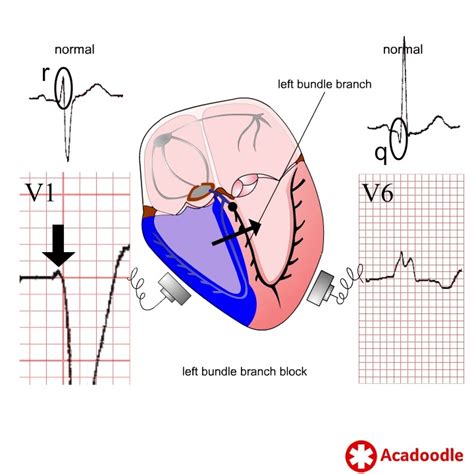 Cardiac MRI Left Bundle Branch Block に対する画像結果