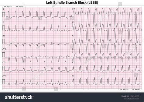 Image result for LBB ECG