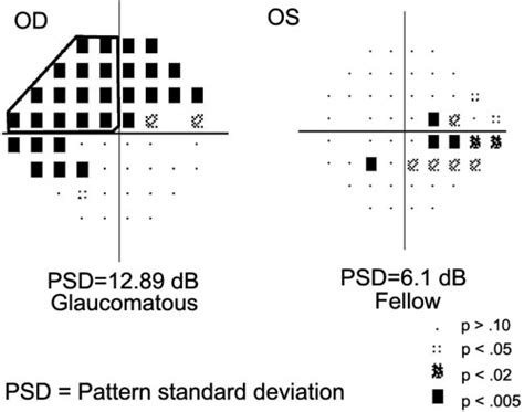 Image result for Visual Field Graph