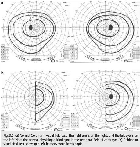 Image result for Neurological Visual Field Examples