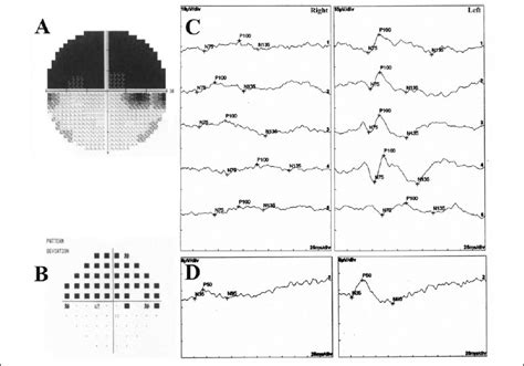 Image result for Altitudinal Visual Field Defect
