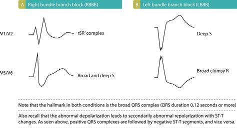 Image result for LBB ECG