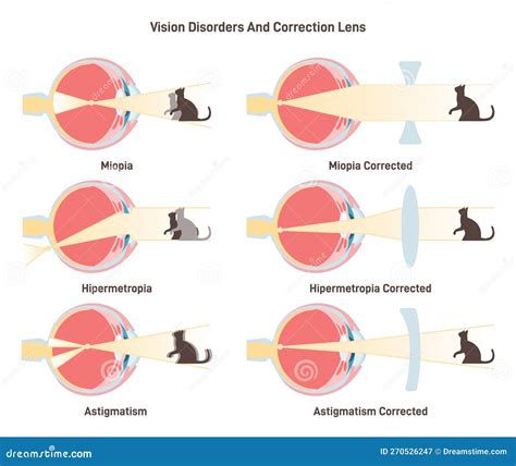 Toradh íomhá ar Normal Vision Hyperopia Myopia