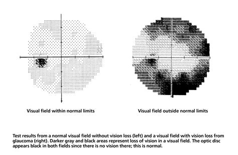 Image result for Macular Split Visual Field Glaucoma
