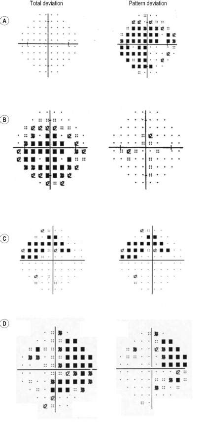 Image result for Visual Field Graph