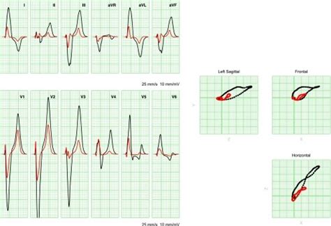 Image result for LBB ECG