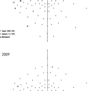 Afbeeldingsresultaten voor Peripheral Visual Field Defect