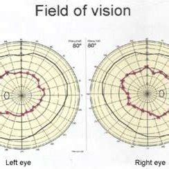 Image result for Normal Perimetry Visual Field Chart