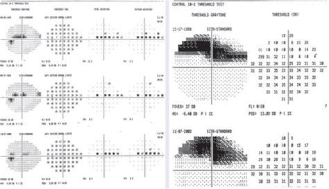 Image result for Paracentral Field Defect