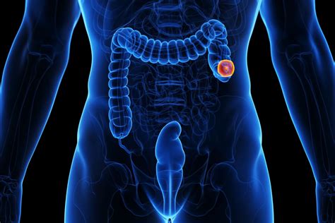 Image result for Colon Resection Coding Cheat Sheet