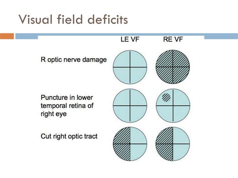 Image result for Deficit in One Visual Field