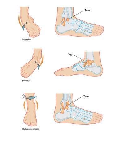 Image result for Inversion Ankle Injury