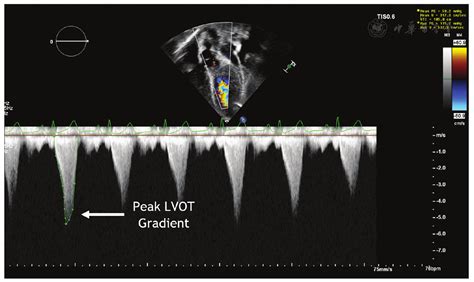 Image result for Intracavitaire Gradient