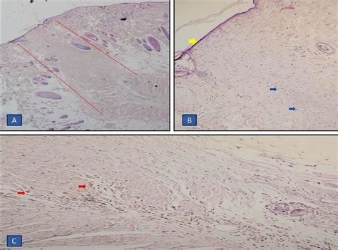 Microscopic view of wound tissues on day (Control group). The area ...