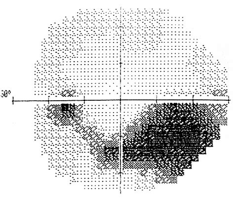 Image result for Visual Field Graph