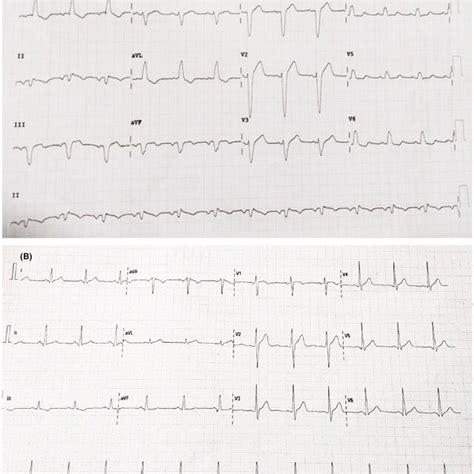 Image result for LBB ECG