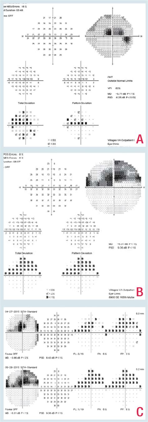 Image result for Advanced Glaucoma Visual Field