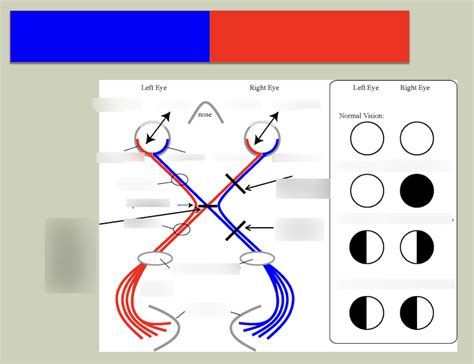 Image result for Visual Field Deficit Chart