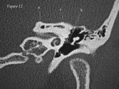 Toradh íomhá ar Temporal Bone CT Scan