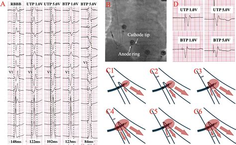 Toradh íomhá ar Left Bundle Branch Block and AFib