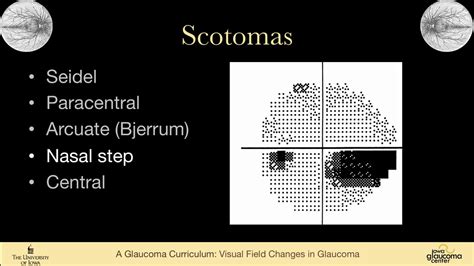 Image result for Advanced Glaucoma Visual Field